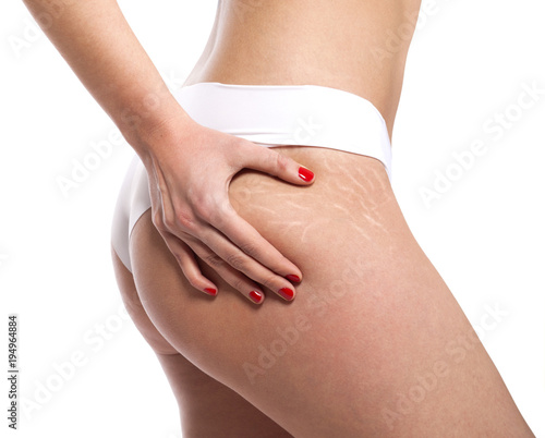 Stretch marks on woman's buttocks