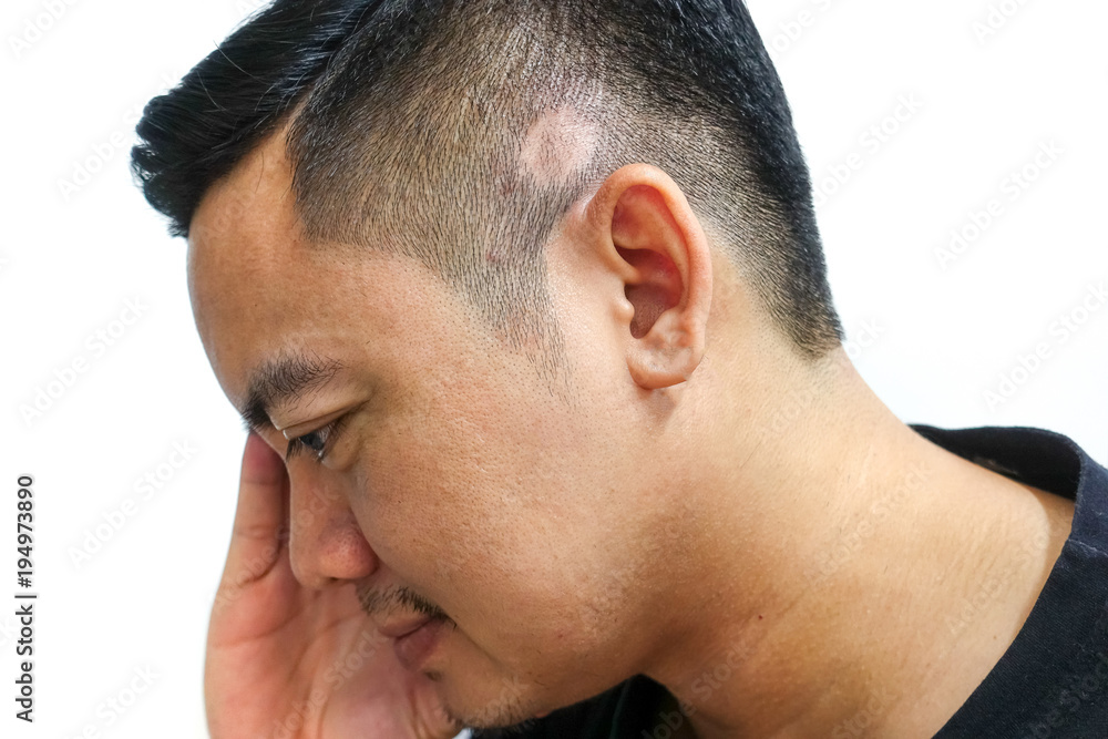Asian men have stress when hair loss is a ring. Asian men have stress when hair loss is a ring.