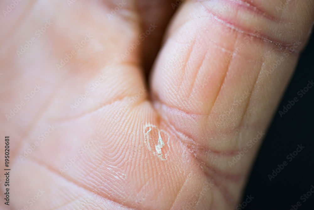 Fototapeta premium Peeling skin on the palms
