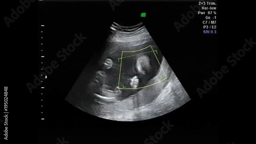 Ultrasound view of pregnancy photo