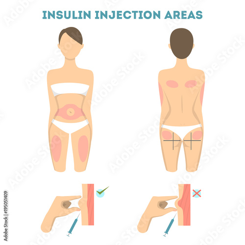 Insulin injections places.