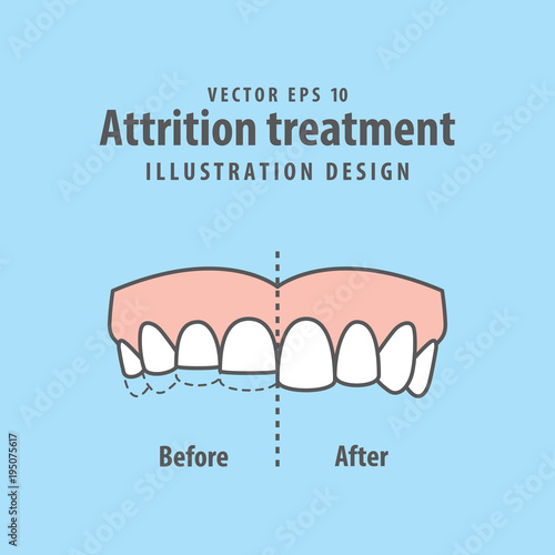 Attrition treatment comparison illustration vector on blue background. Dental concept.