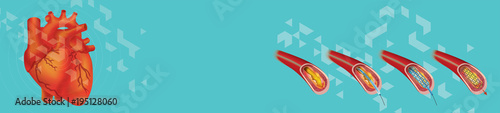 Human Heart banner. Human Heart Balloon Angioplasty, Illustration.