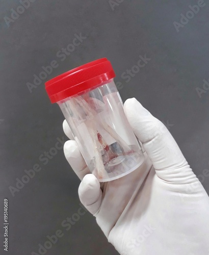 Photos Closeup female hand in white disposable latex glove which holding the sputum specimen container, selective focus