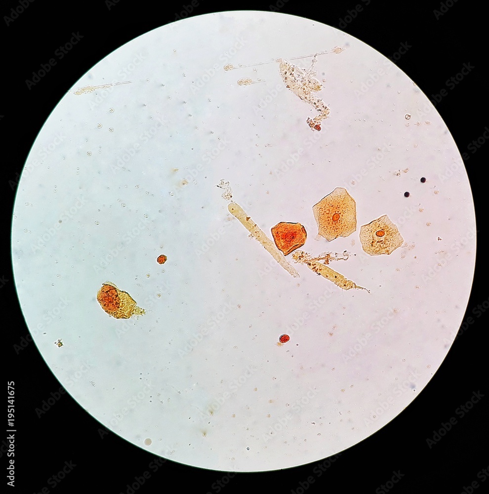 Hyaline Cast In Urine Hyaline Cast In Urine
