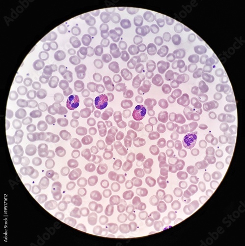 Human blood smear under 100X light microscope with Eosinophils, Neutrophil and hypochromic red blood cells (Selective focus). photo