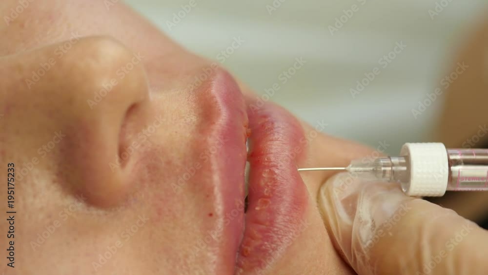 lip Augmentation in a clinic. doctor doing lips injection of botox. 4K lip Augmentation in a clinic. doctor doing lips injection of botox. 4K