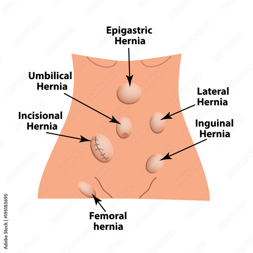 Obraz premium Types of hernia. Epigastric, Lateral, Umbilical, Inguinal, femoral, incisional hernia. intestinal hernia. Infographics. Vector illustration on isolated background.