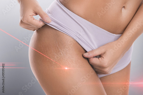 Stretch marks during laser removal session treatment
