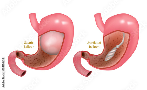 Intra Gastric Balloon. Orbera Gastric Ballon Inside a Stomach
