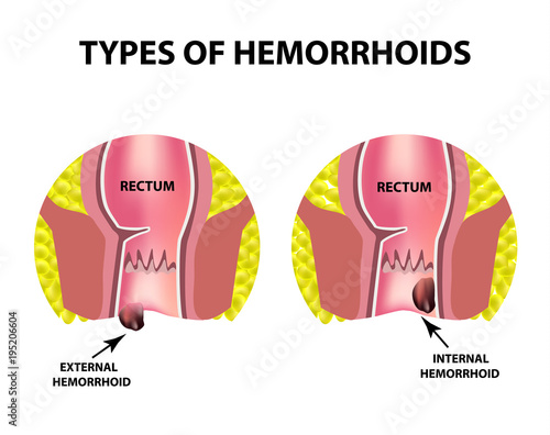 Two types of hemorrhoids are external and internal. Rectum structure. Intestines. colon. Internal and external hemorrhoidal node. Infographics. Vector illustration on isolated background photo