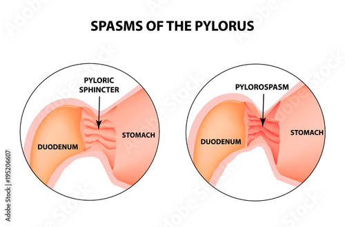 spasms of the pylorus. Pylorospasm. Spastic and atonic. Pyloric sphincter of the stomach. Infographics. Vector image on isolated background photo