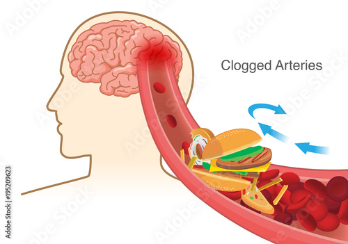 Hamburger and Pizza and French fries block red blood cell cause clogged in artery before into brain. Illustration about stoke disease.