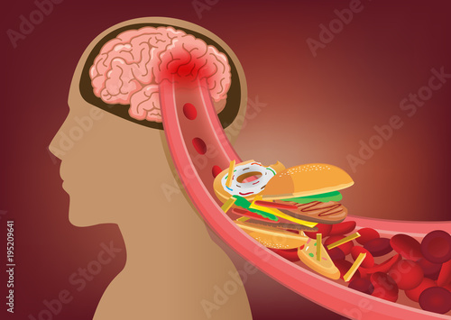 Blood can't flow into human brain because fast food made clogged arteries. Illustration about stoke disease and medical concept.