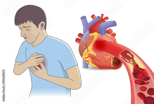 Man have chest pain from blood cell can't flow into heart by fatty. Illustration about Coronary Artery Disease and medical concept.