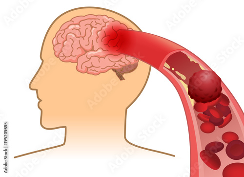 Blood cell can't flow into human brain because clogged arteries by blood clot. Illustration about Stroke and medical concept.