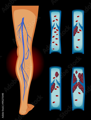 Blood clot in human leg