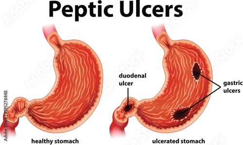 Diagram showing peptic ulcers