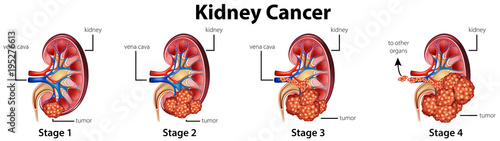 Diagram showing different stages of kidney cancer