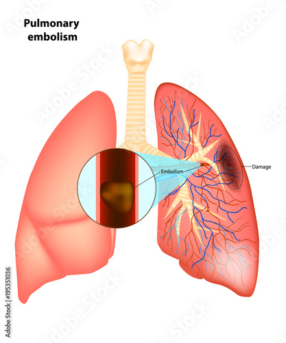 Pulmonary  embolism. Vector illustration