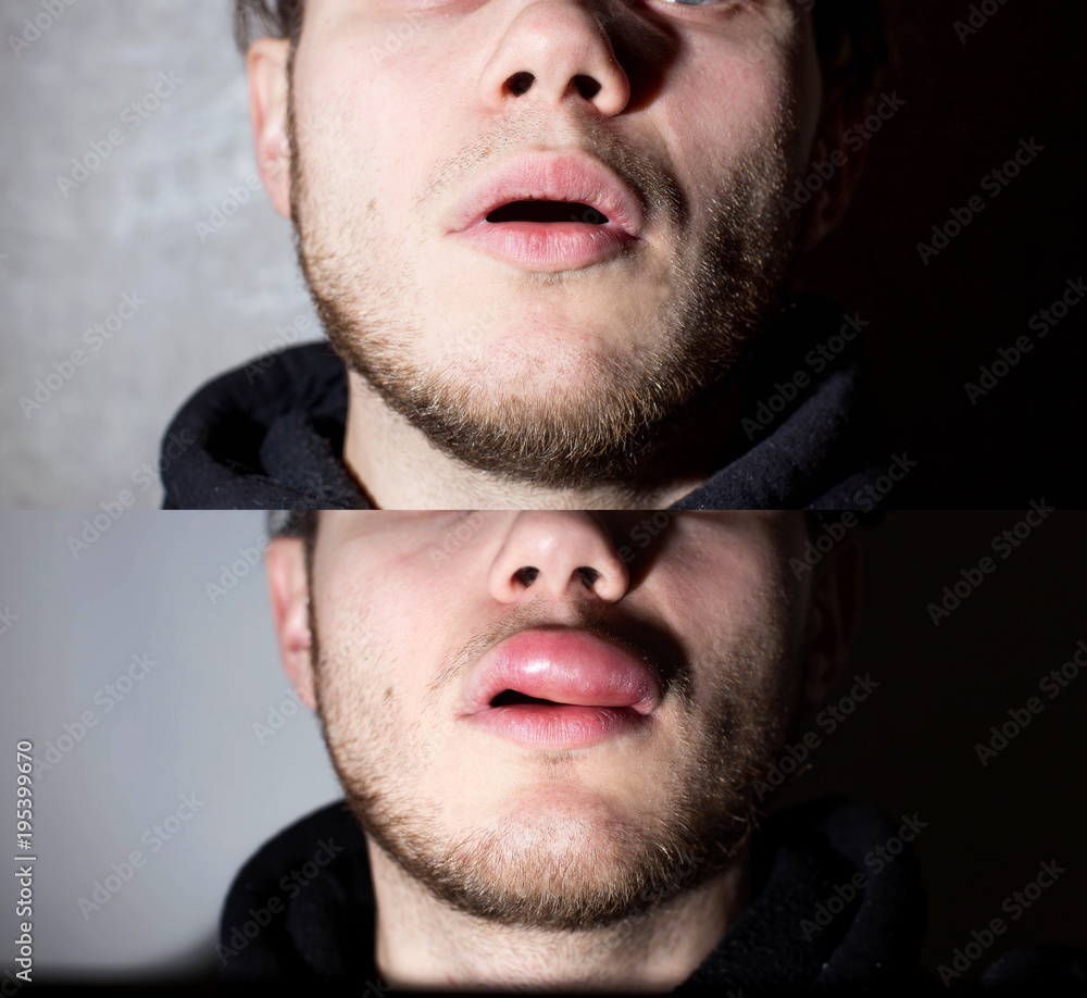 Fototapeta premium allergy on the lip. Angioedema.