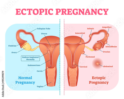 Ectopic Pregnancy or Tubal pregnancy medical diagram with female reproductive system and various embryo attachment locations.  photo