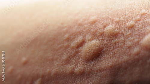 Macro image of symptoms of itchy urticaria or rash photo
