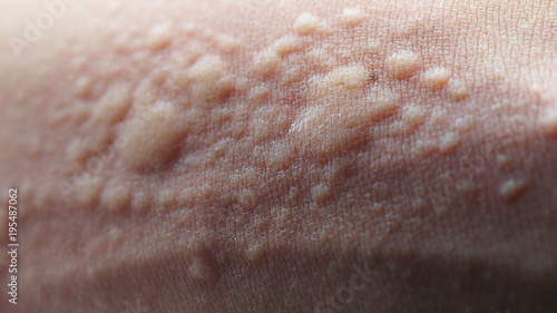 Macro image of symptoms of itchy urticaria or rash photo