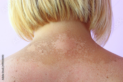 Fotografía Neck burnt after sunburn. Female body