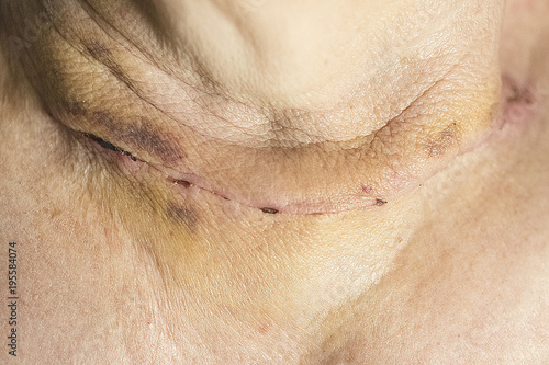 Surgical suture after operation on the thyroid gland.