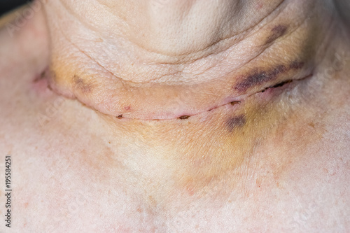 Surgical suture after operation on the thyroid gland. photo