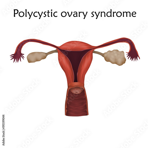 Polycystic ovary syndrome. Human realistic uterus. Anatomy illustration. Colored image, white background. Gynecological diseases.
