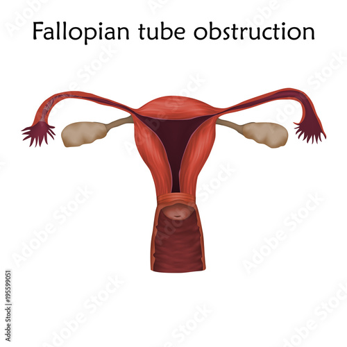 Fallopian tube obstruction. Human realistic uterus. Anatomy illustration. Colored image, white background. Gynecological diseases.
