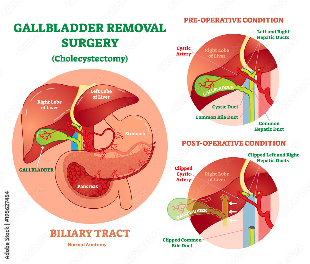 Cholecystectomy Gallbladder removal surgery, anatomical vector illustration diagram with