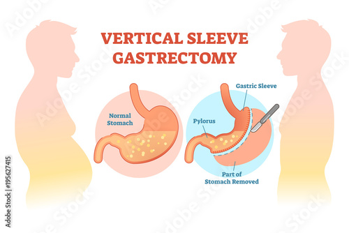 Vertical Sleeve Gastrectomy medical vector illustration diagram with stomach surgical cut.