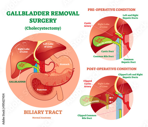 Cholecystectomy - Gallbladder removal surgery, anatomical vector illustration diagram with operative conditions. 