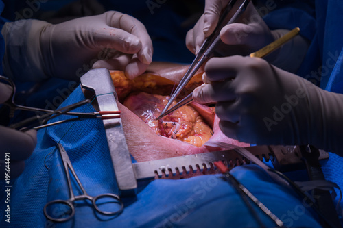 Doctors team wear blue coat perform heart surgery at the operating room in the hospital.