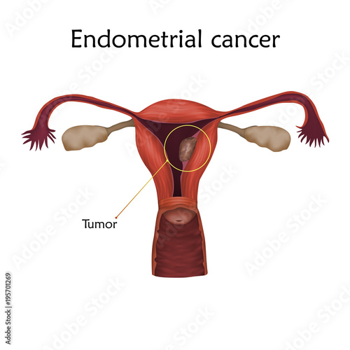 Endometrial cancer. Human realistic uterus. Anatomy illustration with specification. Colored image, white background. Gynecological diseases.