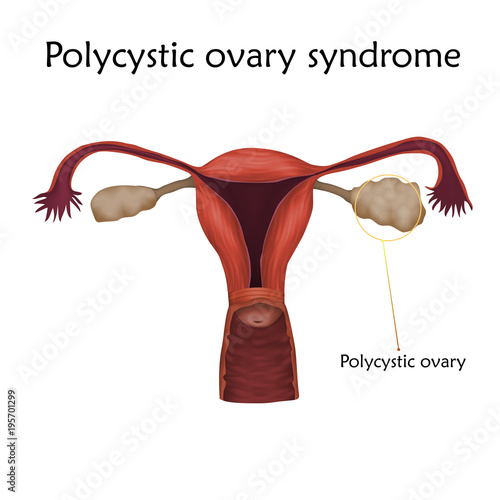 Polycystic ovary syndrome. Human realistic uterus. Anatomy illustration with specification. Colored image, white background. Gynecological diseases.