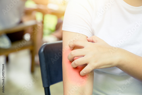 Dermatitis skin allergy: women hand itching scrashing red arm skin