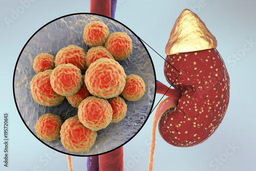 Pyelonephritis, medical concept, and close-up view of bacteria Staphylococcus, the common causative agent of kidney infection, 3D illustration photo