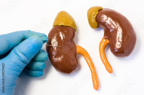 Kidney or renal biopsy or puncture procedure concept photo. Doctor holding puncture needle and punctures kidney anatomical shape on white table. Renal biopsy operation to obtain tissue for analysis