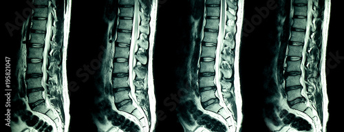 MRI scan of lumbar spines of a patient with chronic back pain.