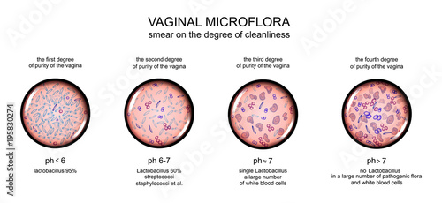 vaginal microflora. degree of purity of the vagina photo