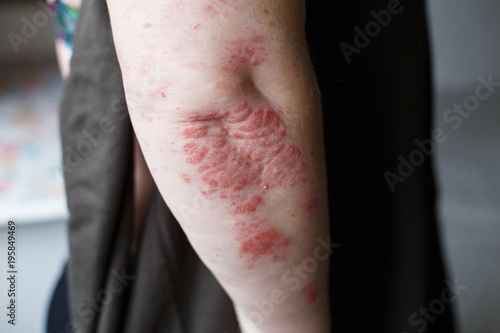 Psoriasis skin. Psoriasis is an autoimmune disease that affects the skin cause skin inflammation red and scaly. Eczema skin © Ольга Тернавская