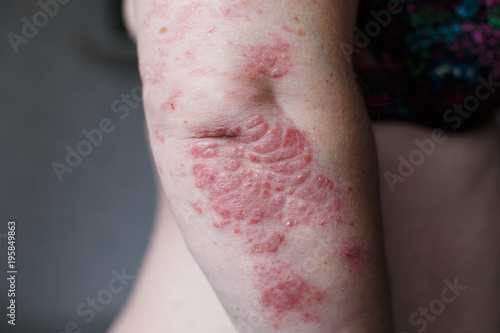 Psoriasis skin. Psoriasis is an autoimmune disease that affects the skin cause skin inflammation red and scaly. Eczema skin
