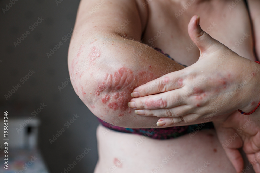 People scratch the itch with hand, Arm, itching, Concept with Healthcare And Medicine. Eczema or psoriasis on hand People scratch the itch with hand, Arm, itching, Concept with Healthcare And Medicine. Eczema or psoriasis on hand