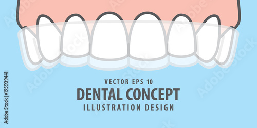 Banner Upper Essix retainer illustration vector on blue background. Dental concept.