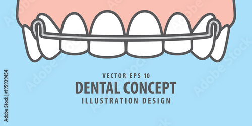 Banner Upper Hawley retainer illustration vector on blue background. Dental concept.