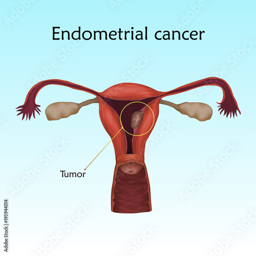 Endometrial cancer. Human realistic uterus. Anatomy illustration with specification. Colored image, blue background. Gynecological diseases.